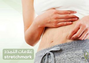 stretchmarks-pearl-dermatology Dermatology Clinic Laser Center Clinic and Skin Care