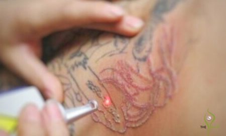 tattoo removal Dermatology Clinic Laser Center Clinic and Skin Care