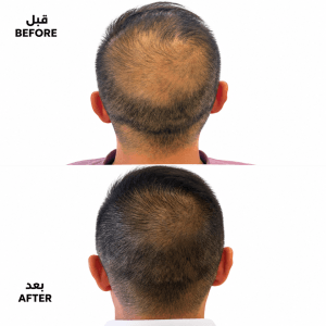 Clinical Hair Density Before and After