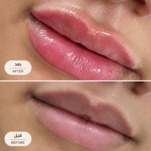 Glossy Lip Enhancement Before and After